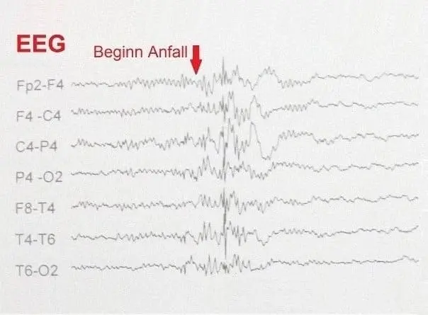 Epilepsie