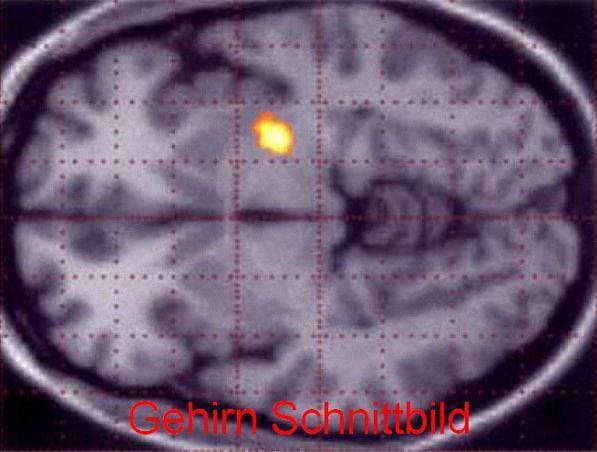basalganglien gehirn pet