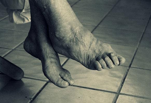 Syndrom der unruhigen Beine / Restless Legs Syndrom (RLS)