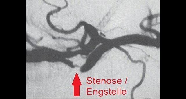 gehirn stenose schlaganfall 1