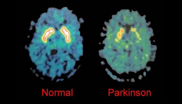 Parkinsonsche Krankheit