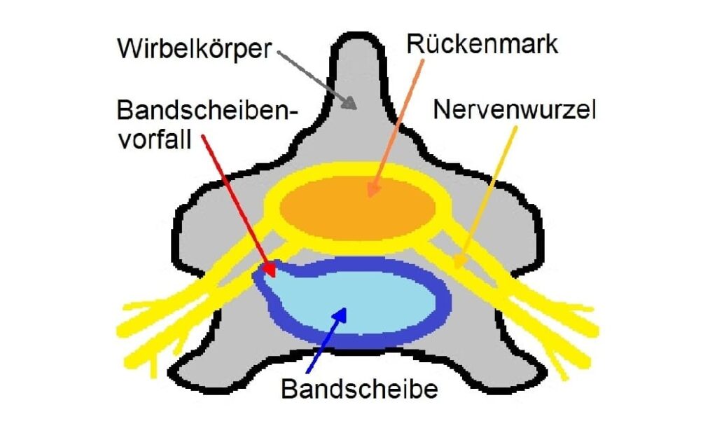 Bandscheibenvorfall
